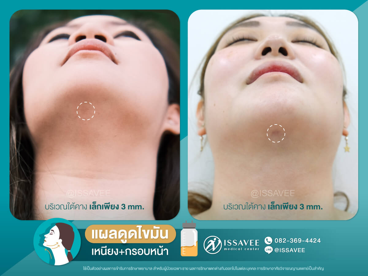 Issavee Clinic ดูดไขมันเหนียง คาง แก้ม เห็นผลหลังทำทันที