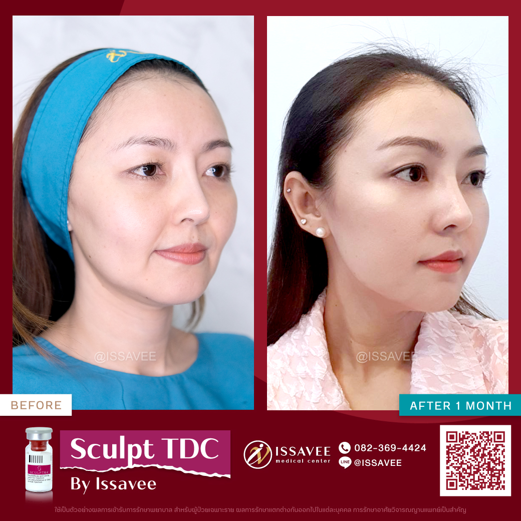 เจาะลึก Sculptra สารกระตุ้นคอลลาเจน คืออะไร? เหมาะกับใคร? | ISSAVEE CLINIC